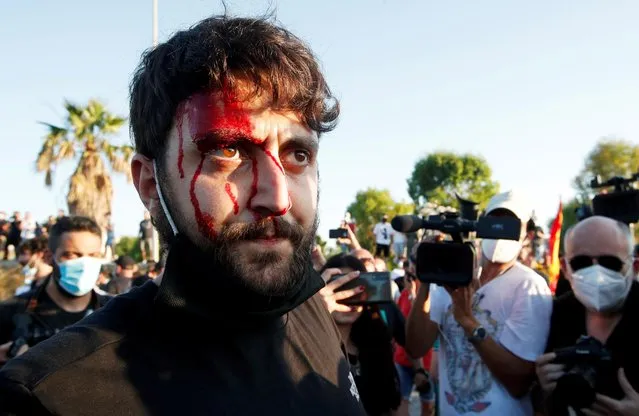 An injured man is seen after clashes between people and police during a visit of Italy's far-right League party leader Matteo Salvini at a village near Naples, after more than 40 people tested positive for the coronavirus disease (COVID-19) in a residential complex, in Mondragone, Italy, June 29, 2020. (Photo by Ciro de Luca/Reuters)