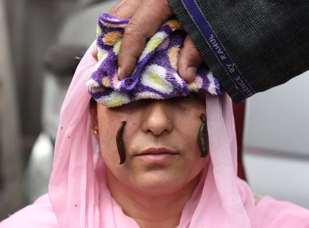Leeches suck blood from a woman's face during a leech therapy session on a roadside in Srinagar, Jammu and Kashmir, India, 21 March 2023. The therapy is used to heal pain and other skin ailments and has been used for centuries in traditional medicine. Leeches are primarily used as a legitimate treatment that can help heal skin grafts and restore blood circulation. During the therapy, the leeches are placed on the patient's skin, where they suck blood and release saliva, which contains anticoagulants and other therapeutic compounds. (Photo by Farooq Khan/EPA/EFE)