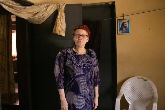 Health in a Heating World (series) | Sun, Not Salt by Ayomitunde Adeleke. “There’s evidence that rising temperatures are increasing the risk of skin cancer – a particular danger to people with albinism. In Nigeria, the connection is not always well understood, and people often think the symptoms are caused by eating too much salt. Victoria lost her brother and sister to skin cancer. Their jobs exposed them to harsh sunlight every day. After uncertainty about why they were getting ill, they were eventually taken to hospital, but by then it was too late”. (Photo by Ayomitunde Adeleke/Wellcome Photography Prize 2021)