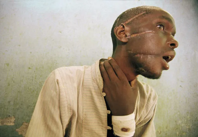 In this June 4, 1994, file photo, Nyabimana (first name unknown), 26, who was evacuated after being found by the Red Cross wandering in Kabgayi, about 15 miles southwest of the capital Kigali, shows machete wounds at an International Committee of the Red Cross hospital in Nyanza, about 35 miles southwest of Kigali, in Rwanda. The massacres, mostly by gangs wielding machetes, swept across Rwanda and groups of people were killed in their homes and farms and where they sought shelter in churches and schools. (Photo by Jean-Marc Bouju/AP Photo/File)