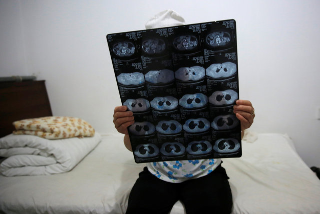 Huang shows her CT scan film in her room at the accommodation where patients and their family members stay while seeking medical treatments in Beijing, China, June 22, 2016. (Photo by Kim Kyung-Hoon/Reuters)