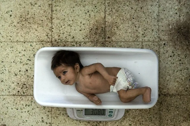 A malnourished baby is weighed at the Indira Gandhi hospital in Kabul, Afghanistan, Sunday, May 22, 2022. Some 1.1 million Afghan children under the age of five will face malnutrition by the end of the year, as hospitals wards are already packed with sick children . (Photo by Ebrahim Noroozi/AP Photo)