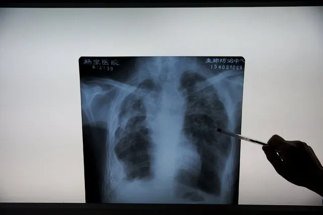 Fu Jianghua, the head of Yangjia Hospital, shows an x-ray image of what he describes as a typical case of pneumoconiosis, a disease caused by the inhalation of dust, at Wuyi County, Zhejiang Province, China October 19, 2015. Fu has worked at Yangjia Hospital since 1983, when it was operated by a local mine, and is now the hospital's head. (Photo by Damir Sagolj/Reuters)