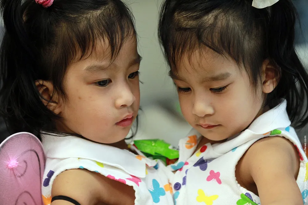 Surgeons Prepare To Separate Conjoined Twin Toddlers