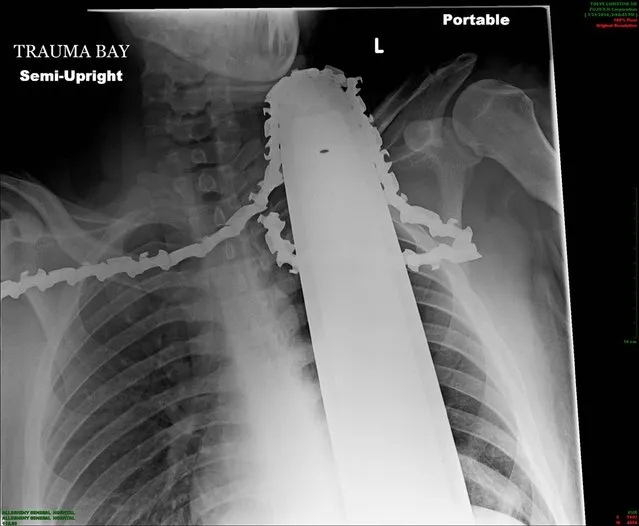 This Monday, March 31, 2014 photo provided by Allegheny Health Network shows an X-ray of a chain saw blade embedded in the neck of a patient, at Allegheny General Hospital, in Pittsburgh. James Valentine, a tree trimmer, was in a tree on Monday afternoon when he was struck in the neck by the saw. Another worker helped him down, and his co-workers left the saw in place to try to limit the bleeding. (Photo by AP Photo/Allegheny Health Network)