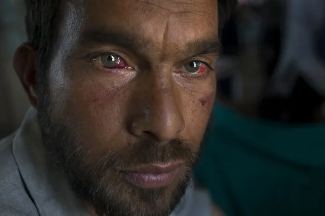 Gulzar Ahmed, allegedly beaten up by Indian soldiers who picked him along with several others at Khrew village, recovers at a local hospital in Srinagar, Indian controlled Kashmir, Thursday, August 18, 2016. Residents of Khrew, in Indian-controlled Kashmir, say a young college teacher has been killed while he was in the custody of the Indian army after soldiers picked up dozens of villagers from their homes in the Himalayan region. (Photo by Dar Yasin/AP Photo)