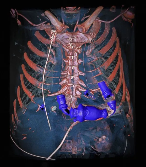 Dual energy computed tomography angiography (DECT) of a human chest. The scan was performed with an extremely low radiation dose on a patient who had received a mechanical heart pump while waiting for a heart transplant. The image was rendered with a 3D volume rendering technique to check the wiring of the pump to the left side of the diseased heart and to the aorta (major artery supplying oxygenated blood from the heart to the rest of the body). The pump connection to the heart was faultless. (Photo by Anders Persson/Wellcome Images)