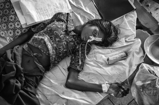 A Rohingya refugee woman suffering from malnutrition and diarrhea lays in the “Rohingya Ward” at Sader Hospital  on October 2, 2017 in Cox's Bazar, Bangladesh. (Photo by Kevin Frayer/Getty Images)