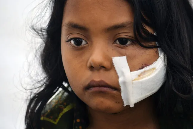 A wounded girl waits for medical attention at a shelter in Mocoa, Putumayo department, southern Colombia on April 3, 2017. Residents of Mocoa were Monday desperately searching for loved ones missing since devastating mudslides slammed into the remote Colombian town, as the death toll soared to over 250, including 43 children. (Photo by Luis Robayo/AFP Photo)