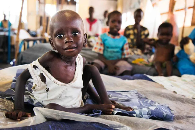 Aleo Tong (1), who suffers severe malnutrition, rests on a bed at the MSF Nutrition centre in Aweil Hospital, on 2 August, 2016. The low rainfall in 2015, the economic crisis and the inflation in the country and a measles outbreak have deteriorated the humanitarian situation in Aweil. 845,000 people, 60% of the population, are in crisis or in emergency food situation. Malnutrition rates are above 30%. Authorities estimate that over 60,000 people from Aweil have fled to Sudan in 2016 due to shortages of food. (Photo by Albert Gonzalez Farran/AFP Photo)