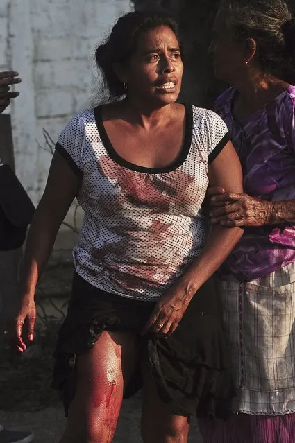 A woman who survived a gunfight shows her wounds in the town of La Concepcion, on the outskirts of Acapulco November 15, 2014. (Photo by Claudio Vargas/Reuters)