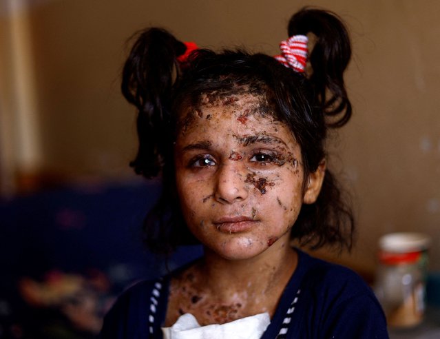 Yara Al-Ghandour, who was wounded in an Israeli strike in Gaza along with her two siblings and mother last month, receives treatment at Nasser Hospital in Khan Younis, Gaza, on Tuesday, August 6, 2024. (Photo by Mohammed Salem/Reuters)