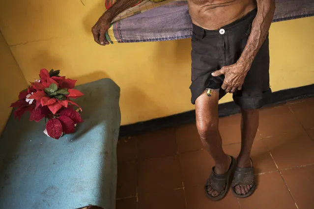 Jose Calderon lifts his shorts to show tubes that are part of his prostrate treatment in Maracaibo, Venezuela, November 20, 2019. The 86-year-old said the tubes should be changed monthly, but he's only been able to afford for them to be replaced twice this year. (Photo by Rodrigo Abd/AP Photo)