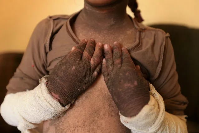 The skin on five-year-old Doaa's arms and neck is blackened after a rocket fired by Islamic State landed and exploded in Qayyara, Iraq, November 12, 2016. (Photo by Air Jalal/Reuters)