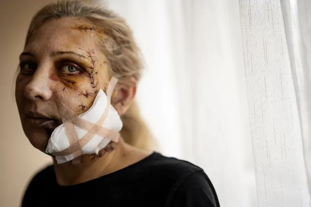 Olha Afanasieva, who was wounded in the Russian missile strike on her apartment building in Dnipro, recovers at a hospital on January 18, 2023. She and her husband were seated at their kitchen table when the missile hit. The blast blew out their windows, and glass and debris shredded half of her face. (Photo by Lynsey Addario/The New York Times)
