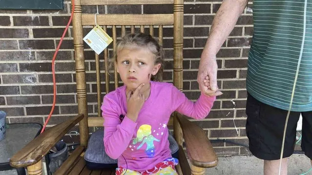 Kinsley White, 6, shows reporters a wound left on her face, Thursday, April 20, 2023 in Gastonia, N.C. A North Carolina man shot and wounded a 6-year-old girl and her parents after children went to retrieve a basketball that had rolled into his yard, according to neighbors and the girl's family – another in a string of recent shootings sparked by seemingly trivial reasons. (Photo by Kara Fohner/The Gaston Gazette via AP Photo)