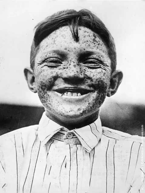 1940: Jack Hexberg, from Portland, the 'Freckle King' of Oregon