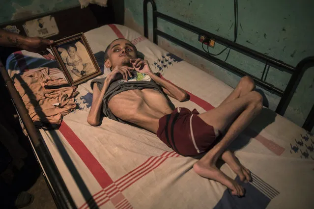 Miguel Blanco, who was born with Hydrocephalus, lays in a bed where his brother places a photograph of him when he was a toddler in Maracaibo, Venezuela, November 27, 2019. Blanco, 28, lives with his unemployed mother who can only afford to feed him once a day. (Photo by Rodrigo Abd/AP Photo)