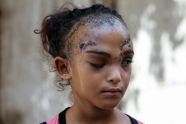 Palestinian girl Sila Houso, who was injured in her head in an Israeli strike, looks on, amid the Israel-Hamas conflict, at Al-Aqsa Martyrs Hospital in Deir Al-Balah in the central Gaza Strip, on August 14, 2024. (Photo by Ramadan Abed/Reuters)