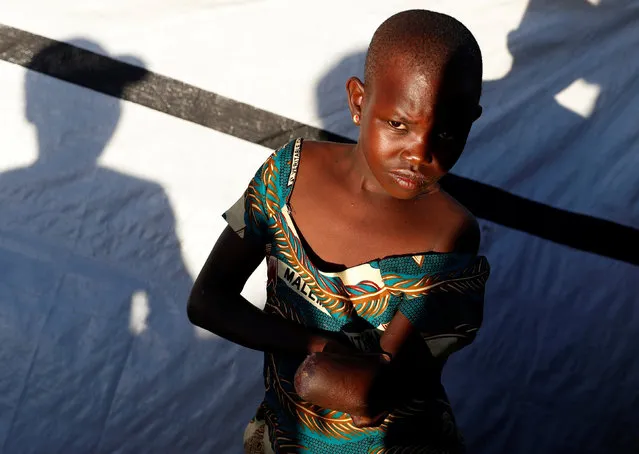 Bunia, Congo, the Democratic Republic of the Mave Grace, 11, whose arm was chopped off by militiamen when they attacked the village of Tchee, stands in an Internally Displaced Camp in Bunia, Ituri province, eastern Democratic Republic of Congo, April 9, 2018. According to witnesses, militiamen killed her pregnant mother, her three brothers and injured her sister, Racahele-Ngabausi. (Photo by Goran Tomasevic/Reuters)