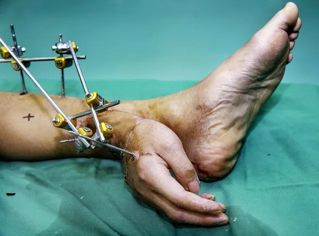 Xiao Wei's severed right hand is seen attached to his ankle before the reattachment surgery at Xiangya Hospital in Changsha, Hunan province, in this December 4, 2013 handout photo provided by Xiangya Hospital, Central South University. According to local media, Xiao Wei's right hand was cut off in an accident during his work at a factory and was grafted to his leg for a month in order to perform the surgery to reattach his hand. (Photo by Xiangya Hospital, Central South University)