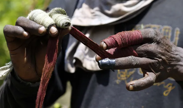 In this March 3, 2017 photo published March 15, a coca picker bandages his hands while harvesting coca leaves in Puerto Bello, in the southern Colombia's state of Putumayo. Coca cultivation surged last year and now covers more territory than it did when a multibillion U.S.-led eradication campaign began 16 years ago, according to a new survey of illegal crops taken by the U.S. government, published Tuesday. (Photo by Fernando Vergara/AP Photo)
