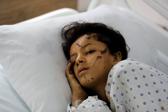 A wounded girl lies in a hospital bed in the southern village of Saksakieh, Lebanon, Tuesday, September 24, 2024. (Photo by Mohammed Zaatari/AP Photo)