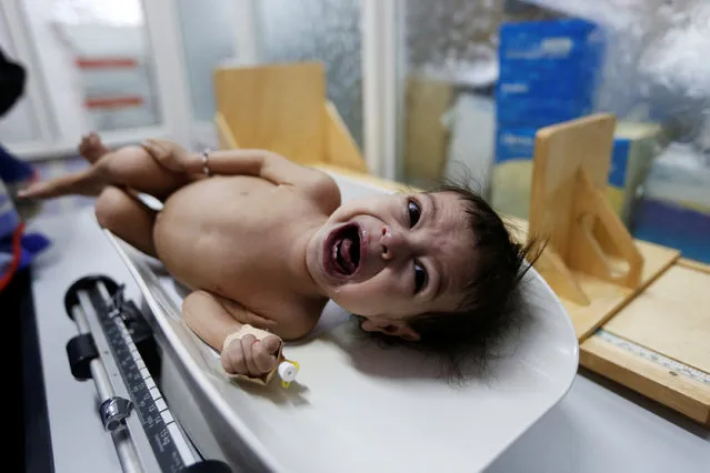 A malnourished girl cries as she is being weighed at a malnutrition treatment center in Sanaa, Yemen October 31, 2016. (Photo by Khaled Abdullah/Reuters)