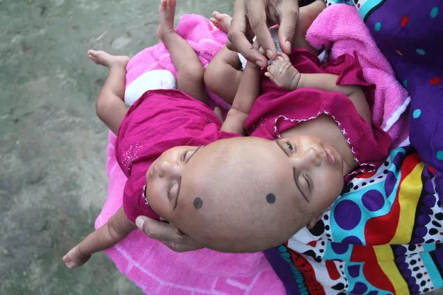 Conjoined baby twins Rabia and Rukia on September 9, 2016 in Pabna, Bangladesh. A mother of conjoined twins is facing an agonising wait to find out whether her baby girls can be separated. Delivered by caesarean at the PDC Clinic in Pabna, North Bangladesh, on July 16 of this year, conjoined twins Rabia and Rukia were born joined at the head. Mum Taslima Khatun Uno and husband Mohammed Rafiqul Islam didn't learn that the twins were conjoined until after the birth. Doctors are monitoring the twins' health in the coming weeks and assessing if and when surgical separation is possible and what the risks are to the babies' lives. (Photo by Rehman Asad/Barcroft Images)