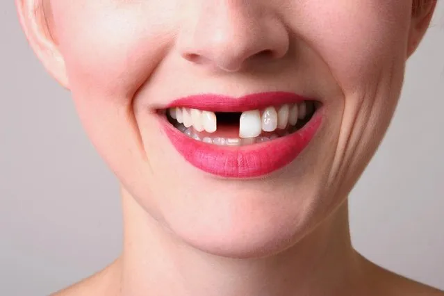A 30 something woman with a missing tooth. (Photo by Sdominick/Getty Images)