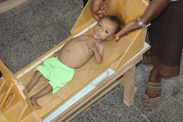 In this Sunday, June 14, 2020 photo, seven-month-old Issa Ibrahim Nasser is measured at a clinic in Deir Al-Hassi, At seven months old, Issa weighs only three kilos. Like him, hundreds of children suffer from acute severe malnutrition because of poverty and grinding conflict. Yemen. (Photo by Issa Al-Rajhi/AP Photo)