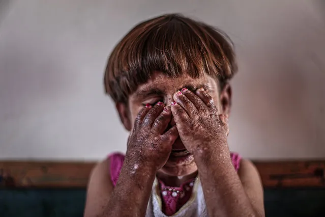 11-year-old Meryem Es-Sah with a severe skin disease “Pemphigus” since she was 3-month old is seen in Idlib, Syria on September 24, 2020. She maintains her life with painkillers as she has pain due to peeled skin of Meryem's face and many parts of her body, and waits for help. Meryem and her family live in an empty class of a school in Ermenez where they settled in 1.5 years ago, escaping from Han Åeyhun district in the south of Idlib to the relatively safer town. (Photo by Muhammed Said/Anadolu Agency via Getty Images)