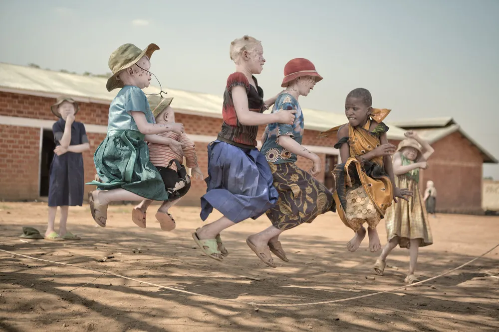 Albinos in Tanzania