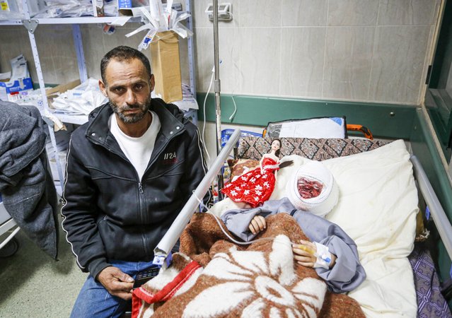 Seca Juneyd, 4-year-old Palestinian girl who suffered deep burns on her face and body as a result of the Israeli army's targeting their house in Jabalia Refugee Camp in the north of Gaza, struggles to survive in pain at Al-Aqsa Martyrs Hospital in Deir al-Balah, Gaza on March 24, 2024. Seca was under treatment at Shifa Hospital but had to be transferred to Al-Aqsa Martyrs Hospital since Israeli army raided the Shifa Hospital. (Photo by Ashraf Amra/Anadolu via Getty Images)