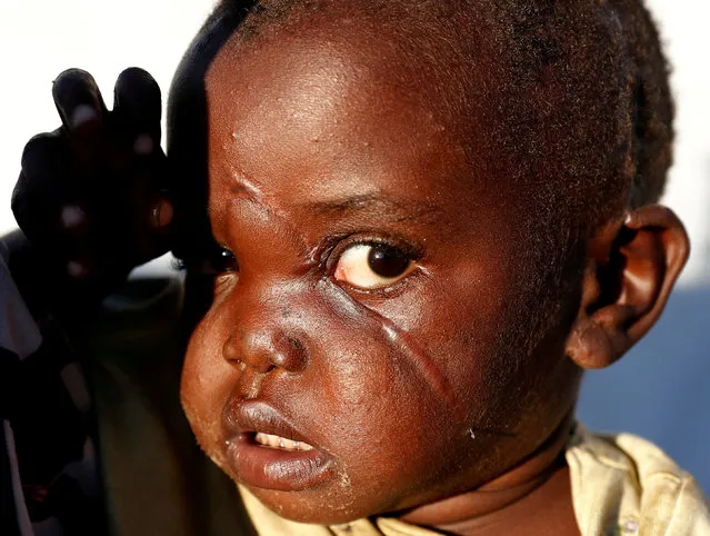 Rachele-Ngabausi, 2, injured by militiamen when they attacked the village of Tchee, stands in an Internally Displaced Camp in Bunia, Ituri province, eastern Democratic Republic of Congo, April 9, 2018. According to witnesses, militiamen killed her pregnant mother, her three brothers and chopped off her sister's arm. (Photo by Goran Tomasevic/Reuters)