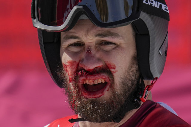 Daniel Hemetsberger, of Austria, bleeds after finishing the men's downhill at the 2022 Winter Olympics, Monday, February 7, 2022, in the Yanqing district of Beijing. (Photo by Luca Bruno/AP Photo)