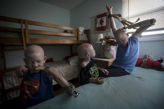 Mwigulu Matonage (L) and Emmanuel Festo (R) put on their prosthetic arms as Baraka Cosmas (C) looks on in their bedroom. (Photo by Carlo Allegri/Reuters)
