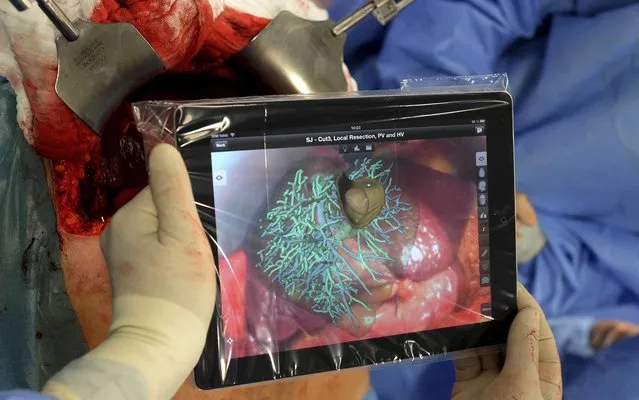 A team of German surgeons led by Professor Karl Oldhafer, the chief physician of general and visceral surgery at the Asklepios Hospital Hamburg, have successfully removed two tumours from a liver with the aid of an iPad, on August 27, 2013. The “iSurgery”, which is being referred to as one of the first surgeries of its kind. The tablet uses augmented reality, which allows the liver to be filmed with an iPad and overlaid during an operation with virtual 3D models reconstructed from the real organ. (Photo by Fabian Bimmer/Reuters)