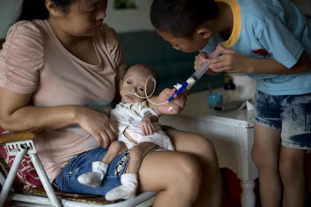 Wu Lunjiao holds her daughter Yuanyuan, who is suffering from an unknown disease, as her son feeds Yuanyuan with milk, by pumping it through a tube into her stomach, at their home in Shenzhen, Guangdong province August 28, 2014. Yuanyuan, who weighs 2.5 kg (5.5 lbs), grew only 0.05 kg after she was given birth 13 months ago. (Photo by Reuters/Stringer)