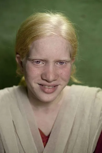 World's Biggest Albino Family