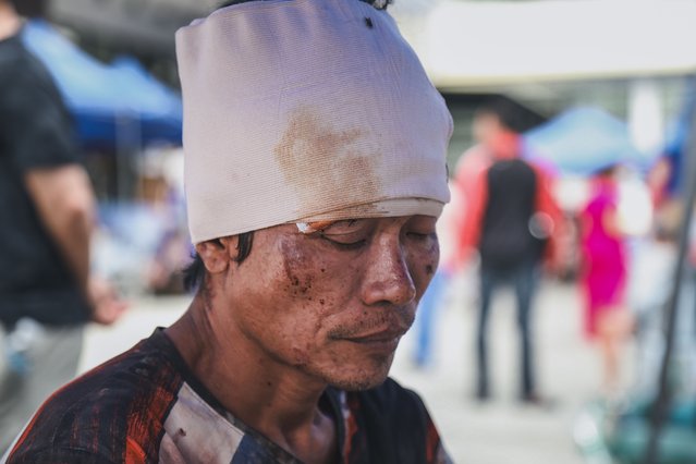 A man injured in an earthquake is seen outside the Cebu Provincial Hospital in Bogo City, Philippines, Wednesday, October 1, 2025. (Photo by Jacqueline Hernandez/AP Photo)
