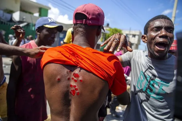 A protester shows his wounds caused by rubber bullets fired by police to disperse protesters demanding the resignation of President Jovenel Moise in Port-au-Prince, Haiti, Saturday, October 17, 2020. (Photo by Dieu Nalio Chery/AP Photo)