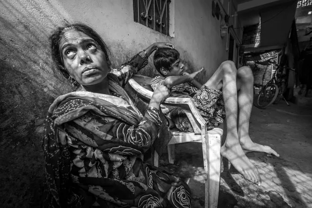 Ateeq, 15 years old, with his mother Shehnaz at home in the Karond neighborhood. Ateeq was born to parents contaminated by a carcinogenic and mutagenic water supply. (Photo by Giles Clarke/Getty Images)