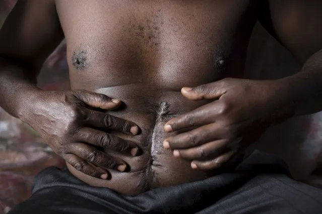 A man shows scars from gunshots wounds he said he sustained when he was attacked by a local gang in Makadera in Nairobi, Kenya, April 27, 2015. The man said the gang accused him of being a police informer. (Photo by Siegfried Modola/Reuters)
