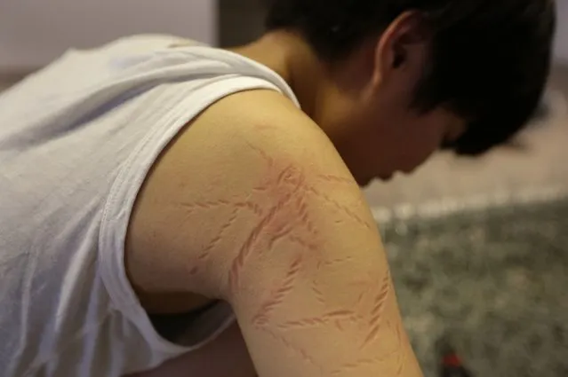 Marks are seen on Chinese artist Zhou Jie's arm after taking a nap on an unfinished iron wire bed, one of her sculptures, at Beijing Art Now Gallery, in Beijing August 11, 2014.  Zhou started her art project titled “36 Days” on August 9, in which she would live inside an exhibition hall with an unfinished iron wire bed, some iron wire sculptures in the shape of stuffed animal dolls, a certain amount of food and her mobile phone for 36 days. According to Zhou, the entire process is open to visitors and she may also interact with them. (Photo by Jason Lee/Reuters)