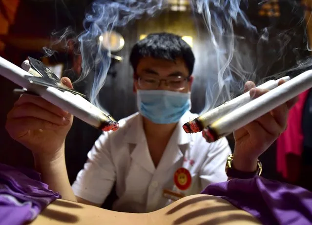 A therapist applies traditional moxibustion treatment on a patient in Yiwu, Zhejiang province, July 13, 2015. Many Chinese believe that applying herbs on acupuncture points during summer can prevent diseases and ailments in the winter. (Photo by Reuters/China Daily)