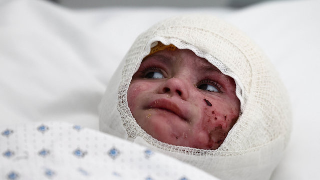 Two-year-old Ivana Skayki, who suffered third-degree burns over nearly half of her body from an Israeli strike in southern Lebanon, looks on as she lies in bed at Geitaoui Hospital in Beirut, Lebanon on October 30, 2024. (Photo by Yara Nardi/Reuters)