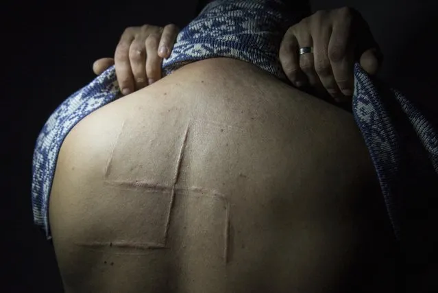 In this photo taken on Wednesday, October 9, 2019, Bogdan Sergiets, former resident of Donetsk, shows a swastika scar on his back in a photographer's studio in Kyiv, Ukraine. Sergiets was captured by Russia-backed rebels in his workplace in Donetsk, he spent 10 hours in captivity, tortured and beaten, and his captors engraved the swastika on his back. (Photo by Zoya Shu/AP Photo)