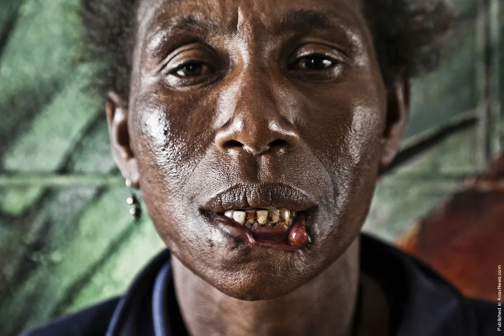 Photographers: Vlad Sokhin. “Violence Against Women in Papua New Guinea”
