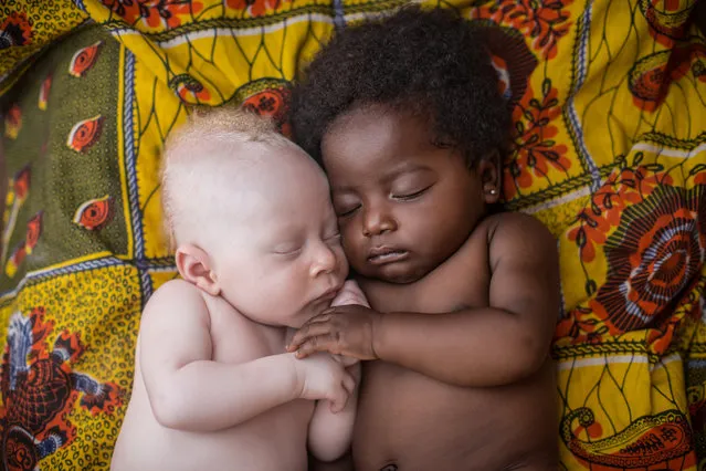 “Basunga”. Basunga (3 weeks-old newborn with albinism) is happily sleeping with his cousin. For now, he does not yet realize the difficulties he will face to integrate into the Congolese society as a PWA. The success of his integration will greatly depends of how he accepts himself and his skin condition a and how educated he will be. Photo location: Kinshasa, Congo RDC. (Photo and caption by Patricia Willocq/National Geographic Photo Contest)